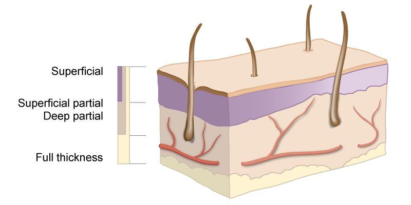 Burn depthes of damage to layers of skin