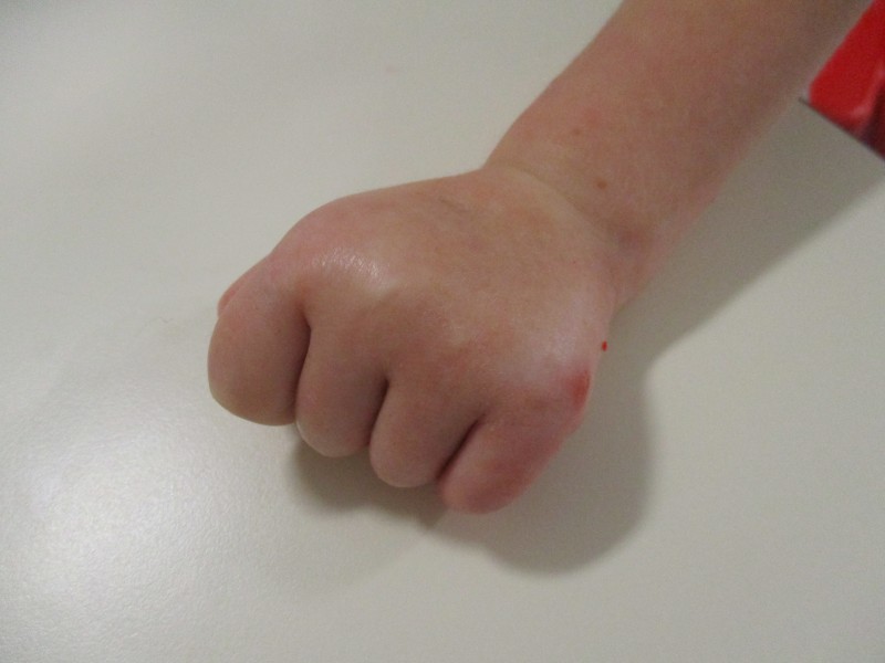 Protective positioning of the hand impacting how a child uses their hand in daily occupations