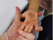 hyper-pigmented hand scar