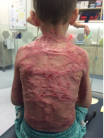 hypertrophic scarring