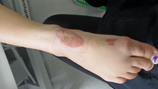 Hypertrophic scarring of the foot