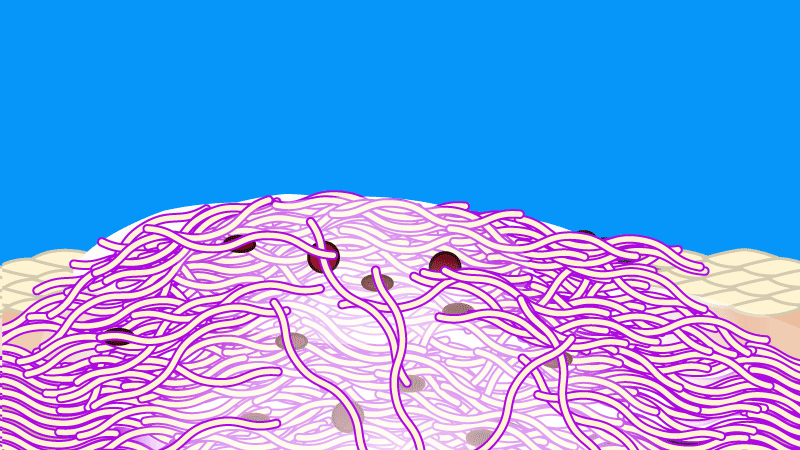 Silicone gel traps transepidermal water loss. Water beading off the scar here simulates the qualities of the protective gel.