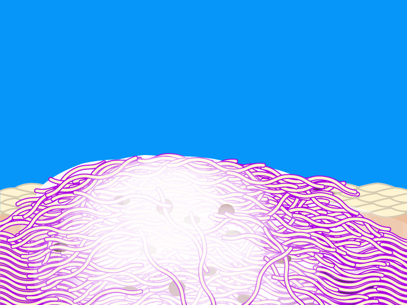 Compression garment application showing flattening of scar and blood dissipation.