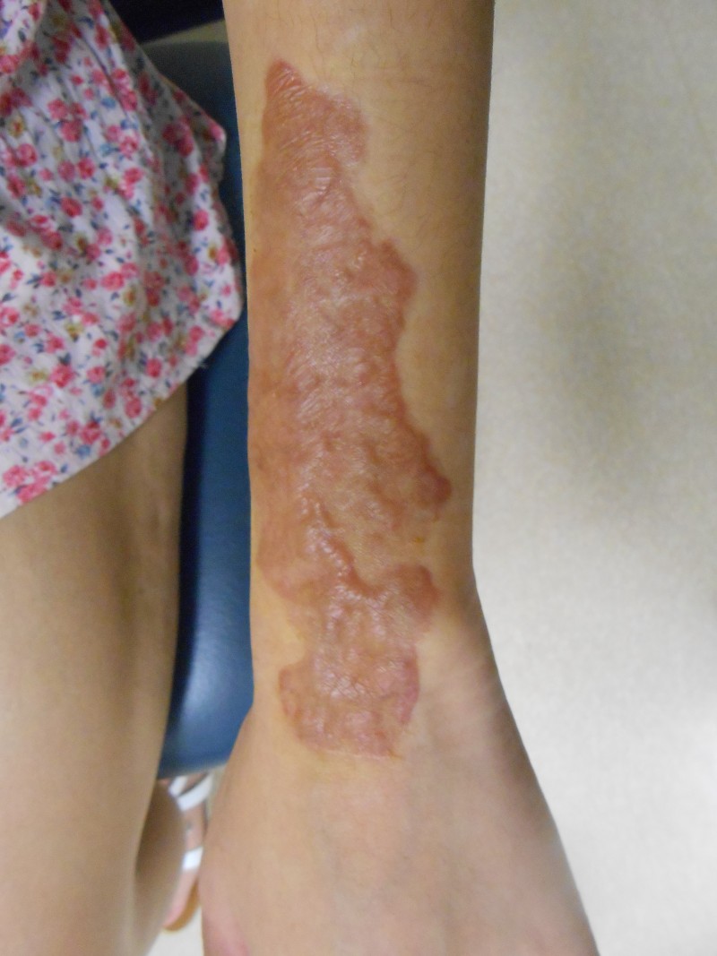 A hyperpigmented scar.