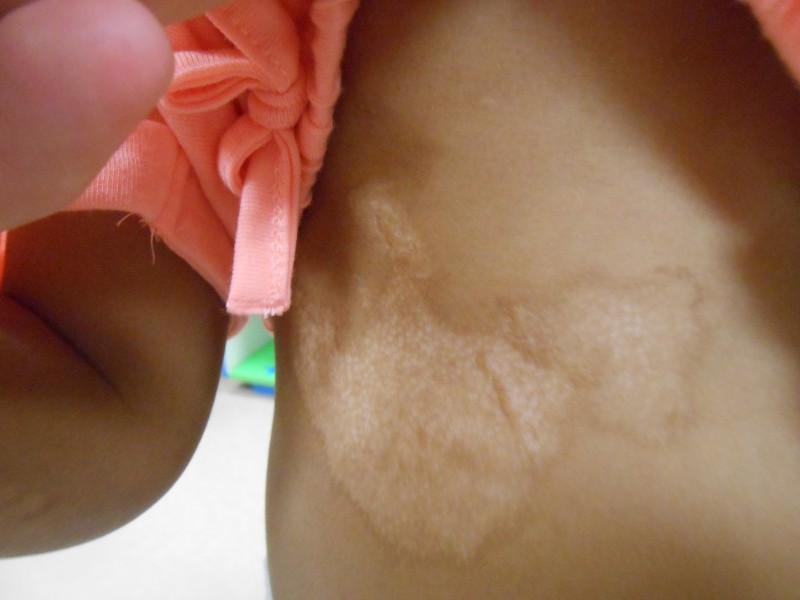 A hypopigmented scar.