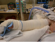 If two splints are required