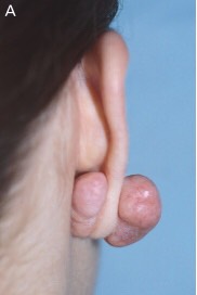 Keloid scarring on the ear likely formed after ear piercing. Despite unlikely being formed from a burn, this photo demonstrates the proliferative growth of this scar in comparison to the original trauma site on the ear.