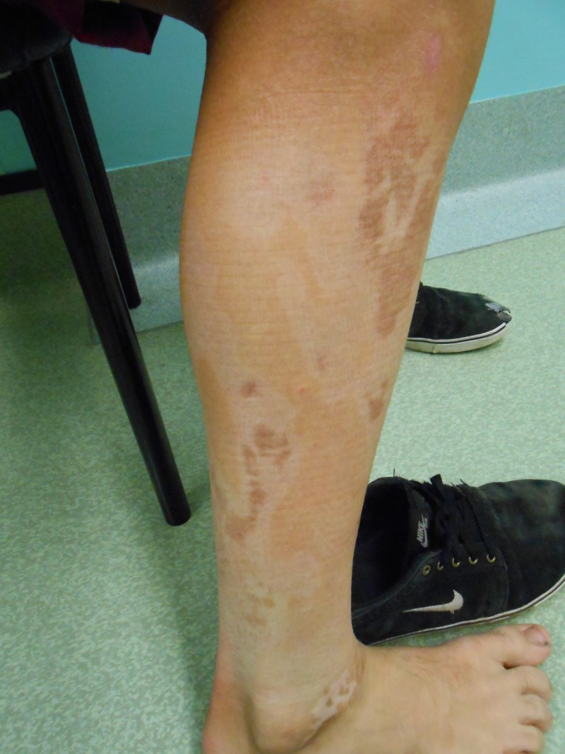 A combination of both hypo and hyper pigmentation.