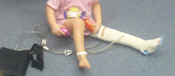Splinting over VAC