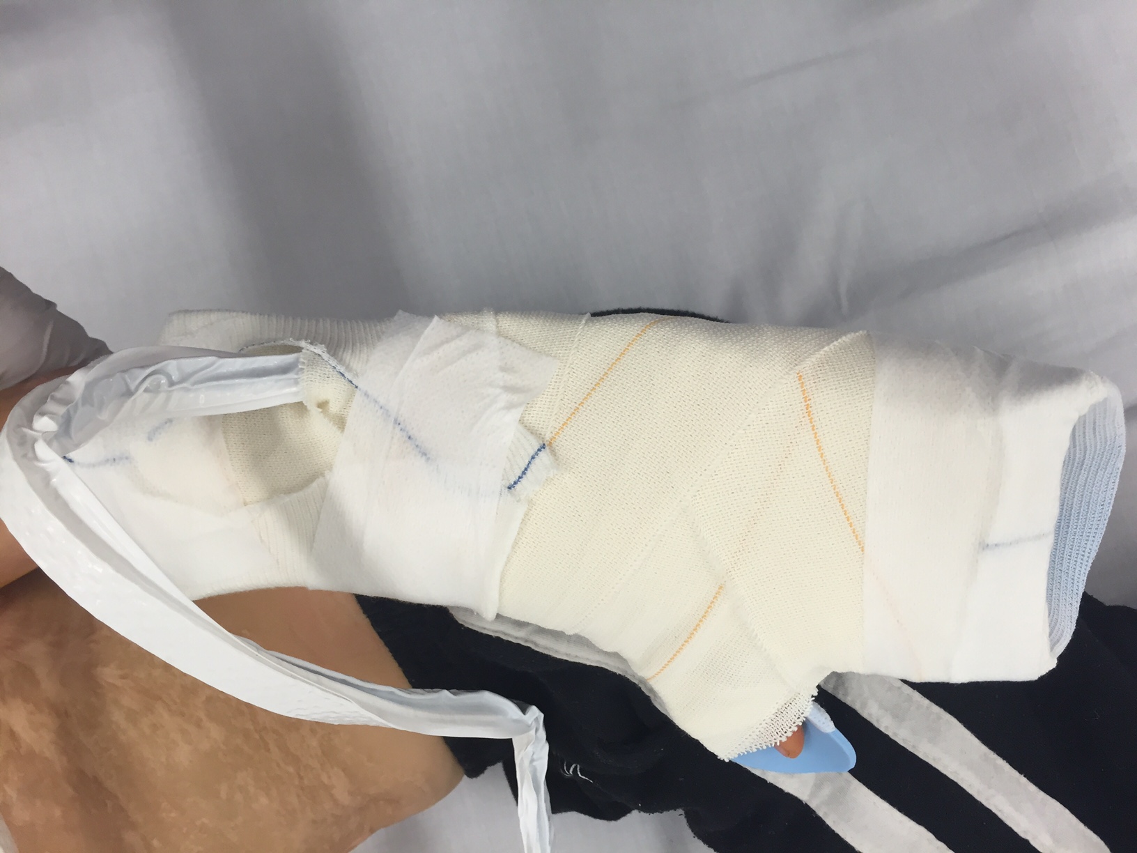 Splinting over negative pressure