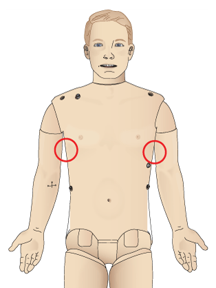Pneumothorax insertion points