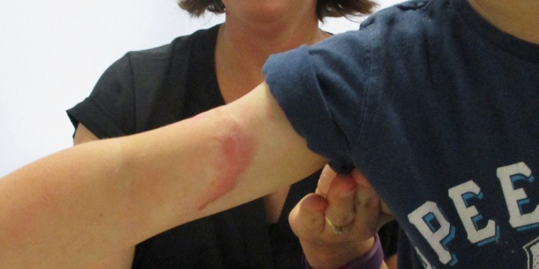 Scar Managment Header TF Consent (3)