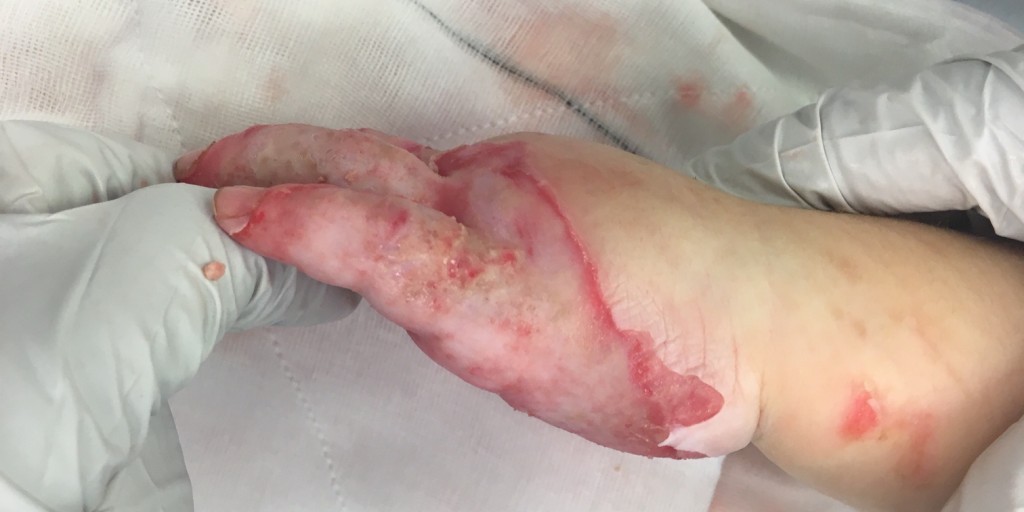 oedema management header hand